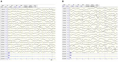 The First Case Report of X-Linked Sideroblastic Anemia With Ataxia of Chinese Origin and Literature Review